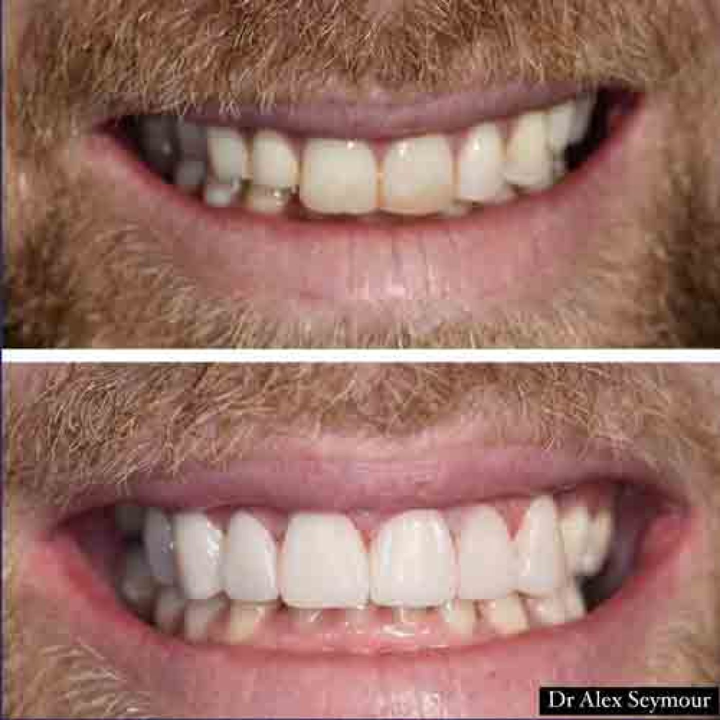 Composite Bonding Gallery Composite Bonding Gallery